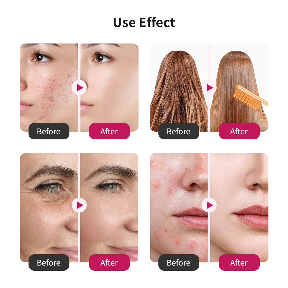 High Frequency Facial Wand — 4 in 1 Skin Therapy Tool